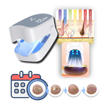 Load image into Gallery viewer, Laser indolore per funghi delle unghie - Ozerty