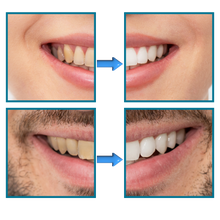 Load image into Gallery viewer, Sbiancamento rapido dei denti - Ozerty